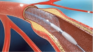Cardiac stent procedure
